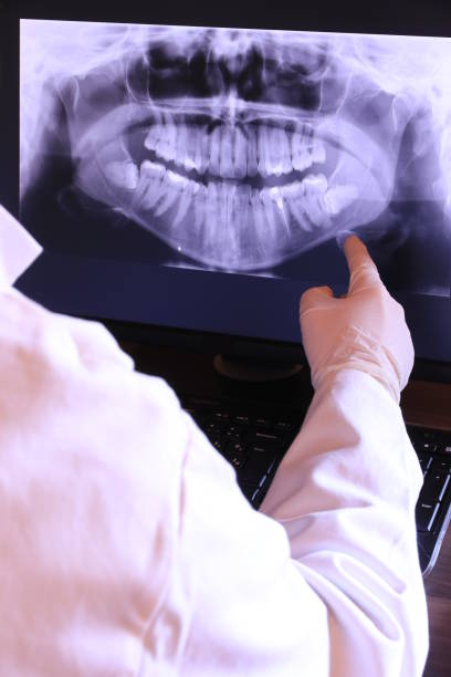 Best Knocked-Out Tooth (Avulsed Tooth) Treatment in Aptos Hills Larkin Valley, CA