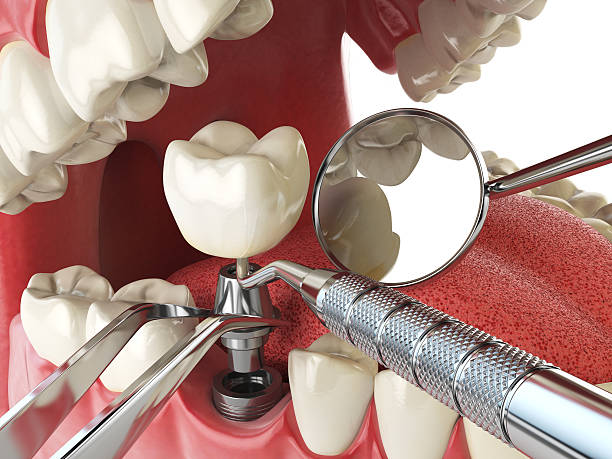Best Emergency Root Canal Therapy in Aptos Hills Larkin Valley, CA
